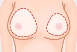 비대칭 교정