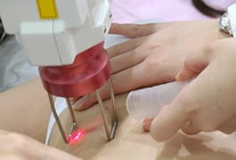 프락셔널레이저