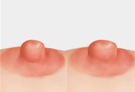 유두의 크기가 비대칭인 경우