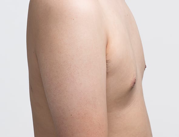 수술 후 6개월