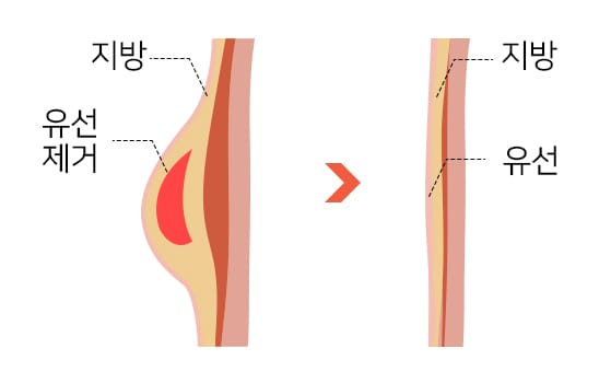 피하 유방 절제술