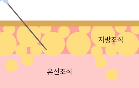 바노바기 부유방 교정술