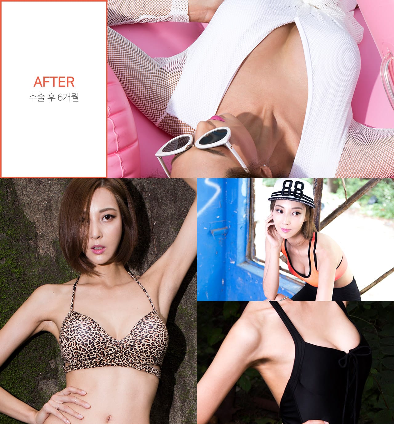 After 수술 후 6개월
