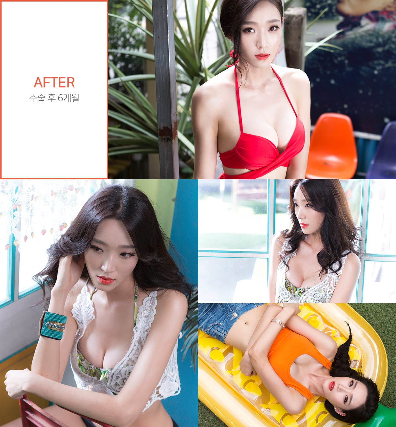 After 수술 후 6개월