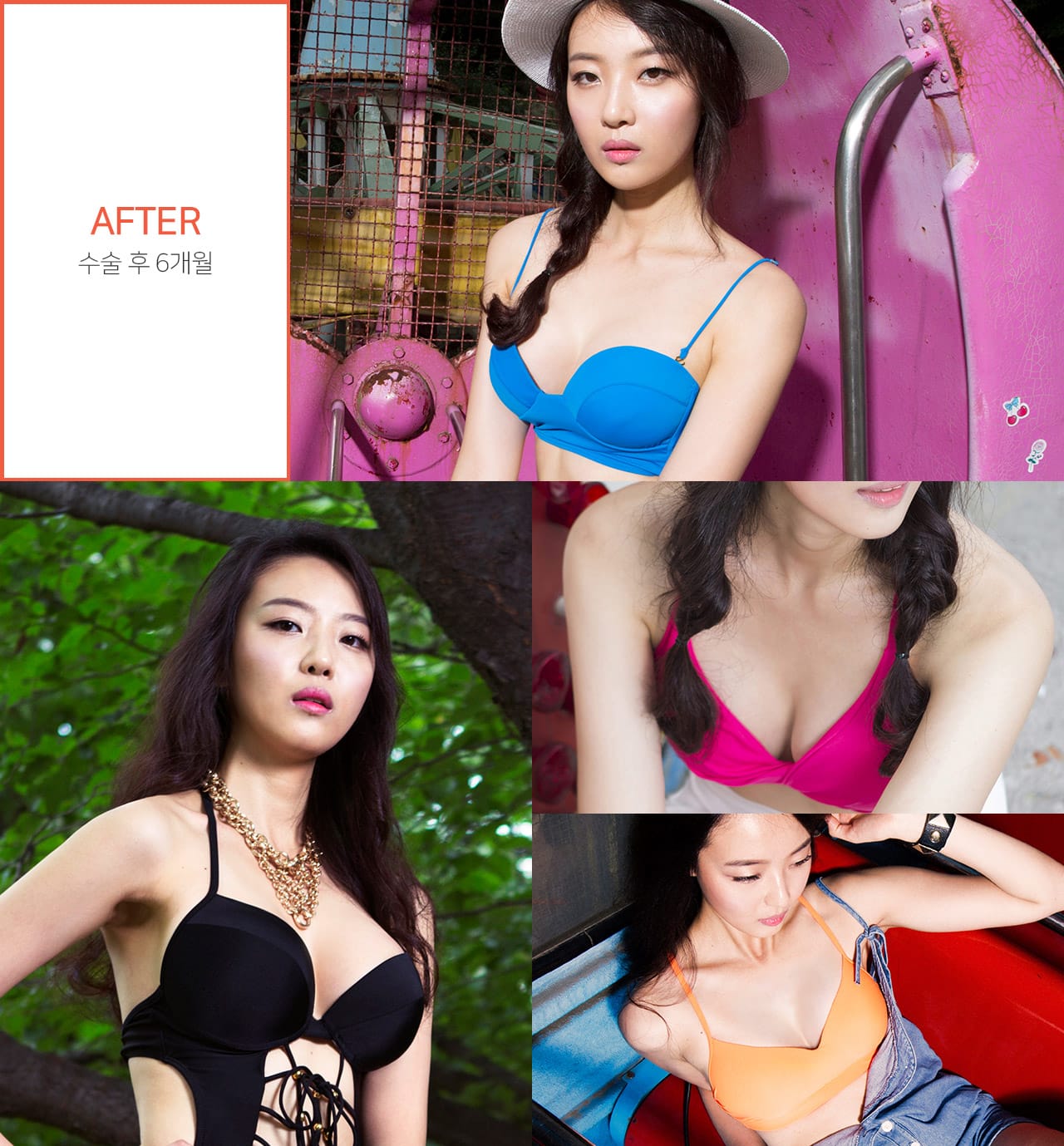 After 수술 후 6개월